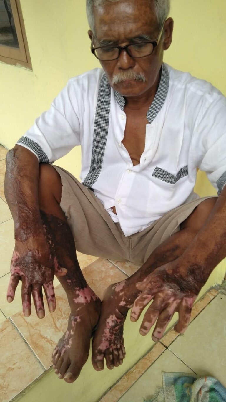 Pegawai Puskesmas Kedung Waringin Tolak Warganya Minta Rekom Yang Kena Luka Bakar 1